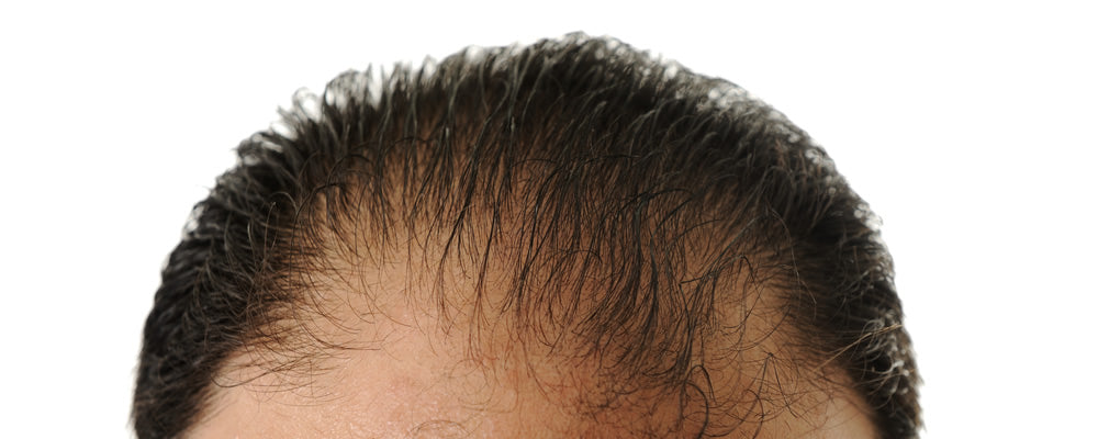 Male Pattern Baldness?