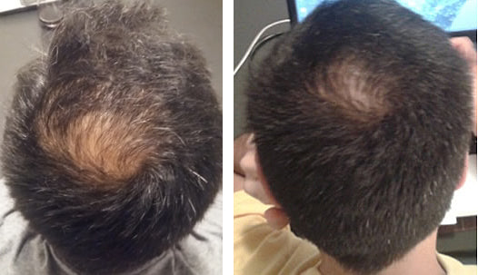 RESEED R8 Botanical Solution for Men 50 ml RESEED R8 Botanical Solution for Men 50 ml - Reseed Hair Loss Range for Men and Women, RESEED R8 Botanical Solution for Men 50 ml - Reseed Hair Loss Range for Men and Women,  100% Natural, Rosemary, Nettle, Horse tail extract, DHT blocker, Increases circulation, Tried and Tested, anti dandruff, controls excess subum secretion, anti fungal, ph balanced scalp