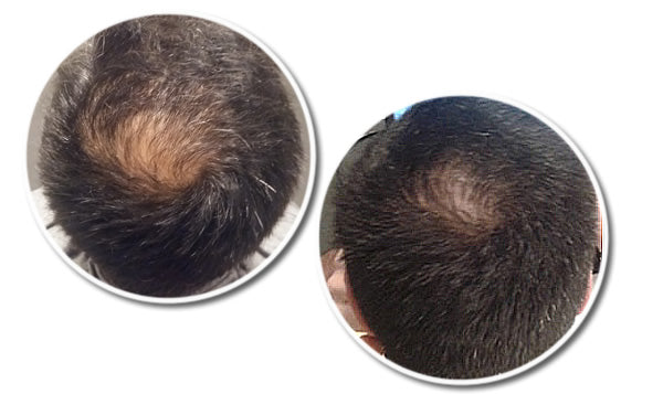RESEED Sabal and Neem Fortifying Shampoo for Men RESEED Sabal and Neem Fortifying Shampoo for Men 250 ml - Reseed Hair Loss Range for Men and Women - Hair Loss before and After