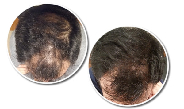 RESEED Sabal and Neem Fortifying Shampoo for Men RESEED Sabal and Neem Fortifying Shampoo for Men 250 ml - Reseed Hair Loss Range for Men and Women