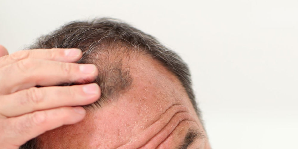 What is Male Pattern Baldness?
